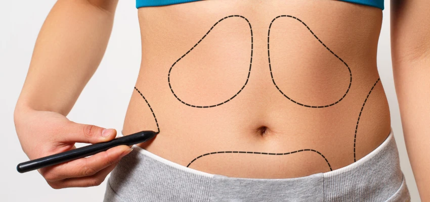 Liposuction in Türkiye: The Ultimate Guide